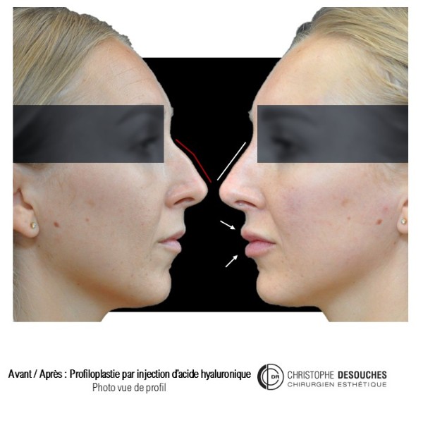 Profiloplastie par injection d&rsquo;acide hyaluronique