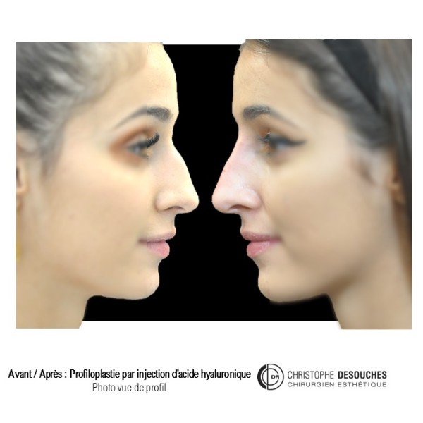 Profiloplastie par injection d&rsquo;acide hyaluronique