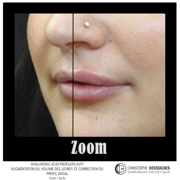 Avant/après profiloplastie médicale par injection d'acide hyaluronique, vue de profil – Dr Desouches, Marseille