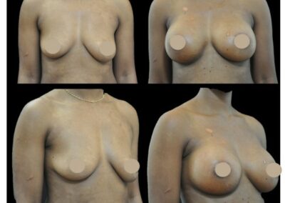 Aumento de senos mediante prótesis