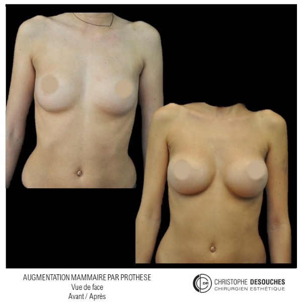 Breast augmentation by prosthesis