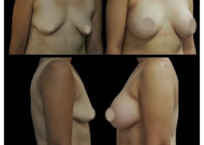 Aumento mamario mediante prótesis y cura de ptosis periareolar