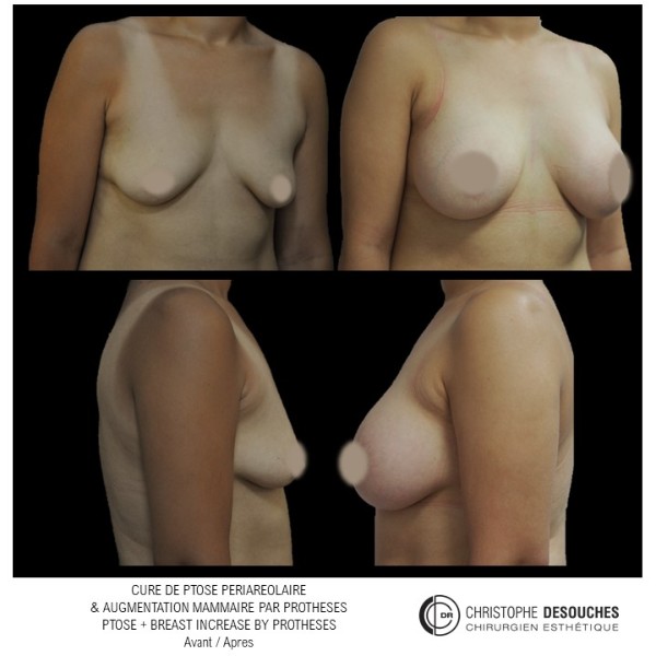 Breast augmentation by prosthesis and periareolar ptosis treatment