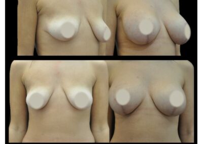 Breast Ptosis