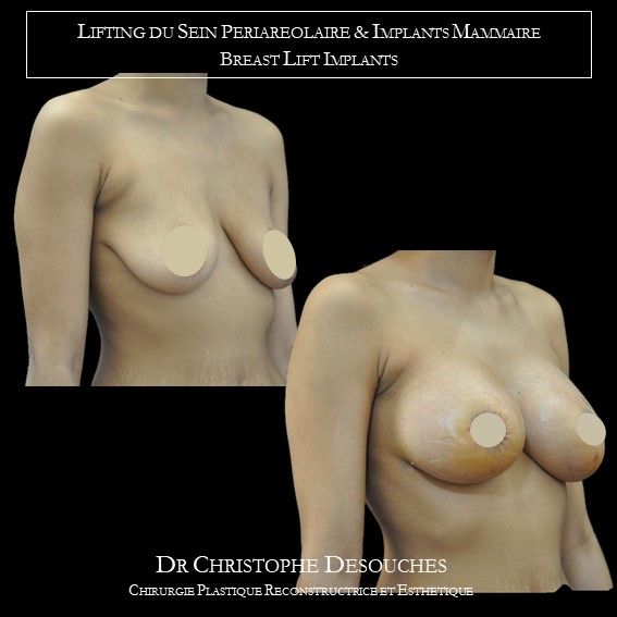 Levantamiento de senos periareolar e implantes mamarios