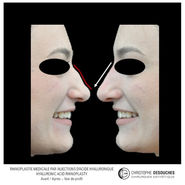 Rhinoplastie médicale : injections d&rsquo;acide hyaluronique pour corriger le profil nasal