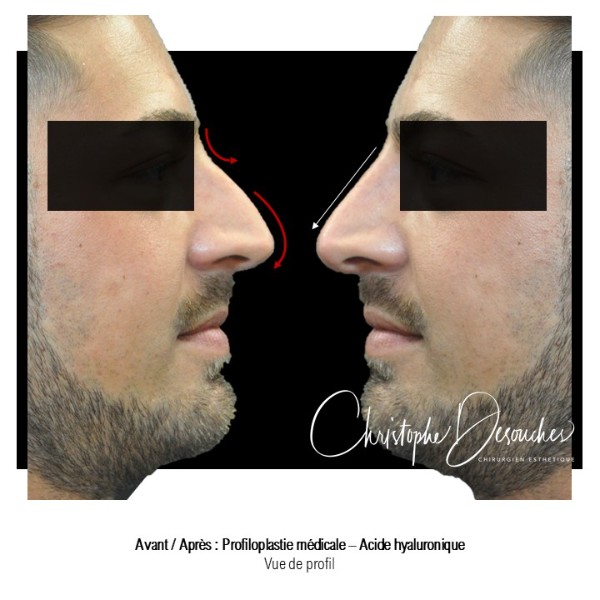 Rhinoplastie médicale chez l&rsquo;homme – injection d&rsquo;acide hyaluronique