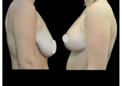 Breast ptosis and lipofilling