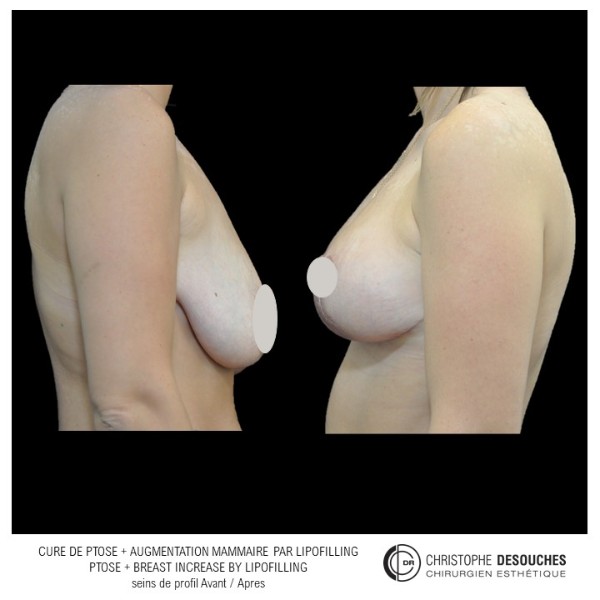 Breast ptosis and lipofilling