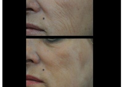 Peeling TCA 30%: una soluzione per rigenerare la pelle e cancellare i segni del tempo