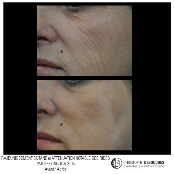 TCA 30% peel: a solution to regenerate the skin and erase the signs of aging