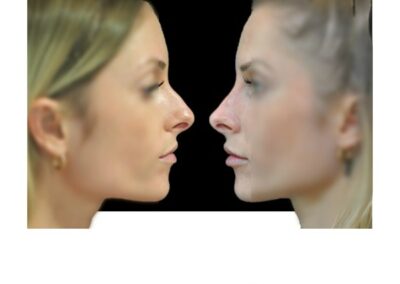 تجميل الوجه فن تنسيق الوجه عن طريق حقن حمض الهيالورونيك