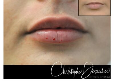 « Russian lips » – Augmentation des lèvres par injection d’acide hyaluronique