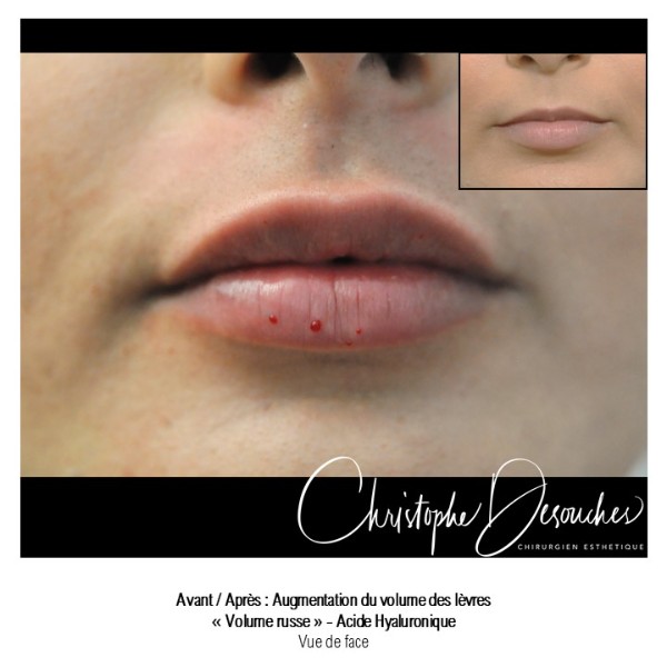 “Labios rusos” – Aumento de labios mediante inyección de ácido hialurónico