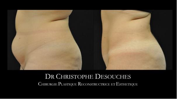 Liposuction