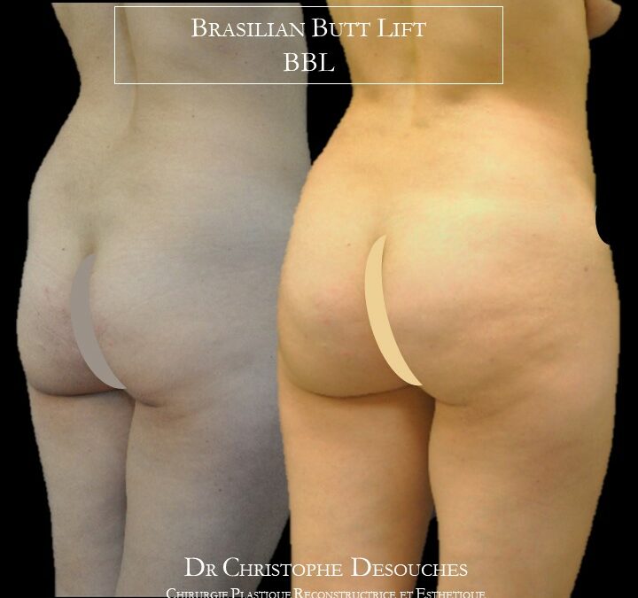 BBL : Lipofilling des fesses avant après