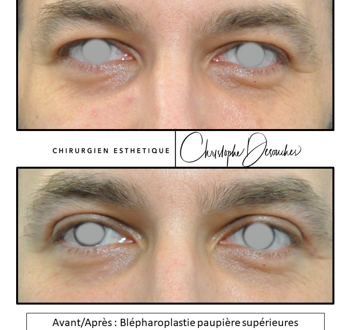 Upper eyelid surgery