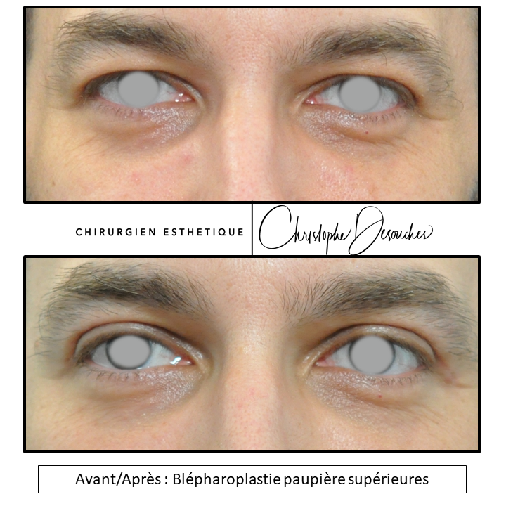 Upper eyelid surgery