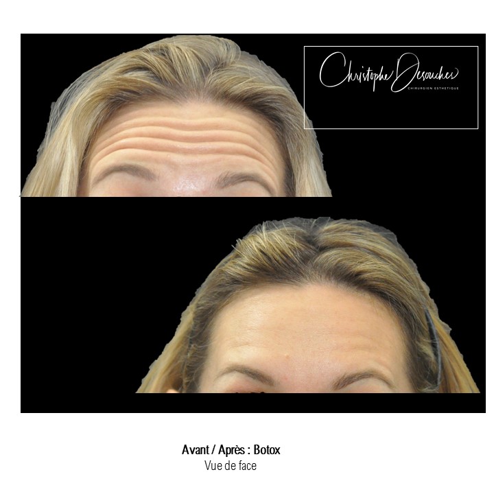 Before and After Botox, Front View