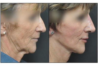 lifting cervico-facciale