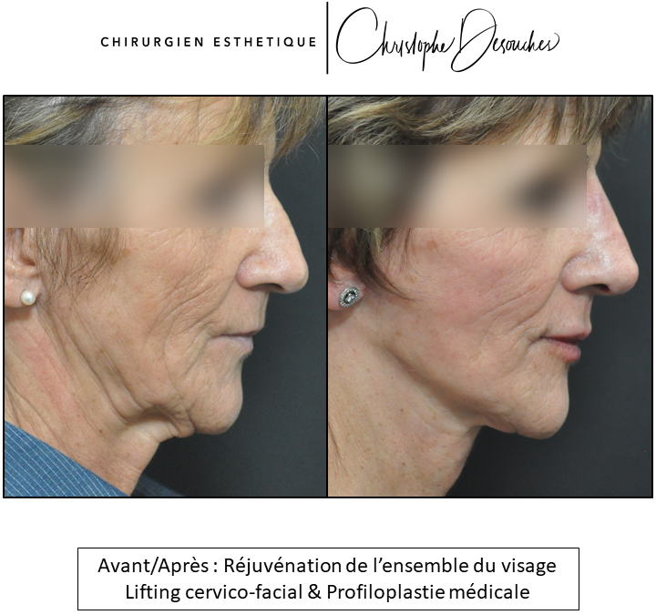 cervico-facial lifting