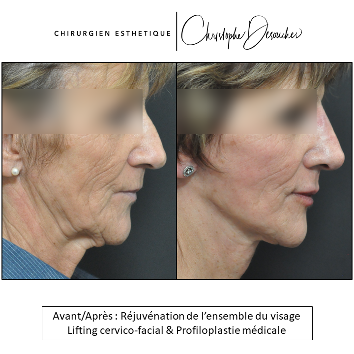 cervico-facial lifting