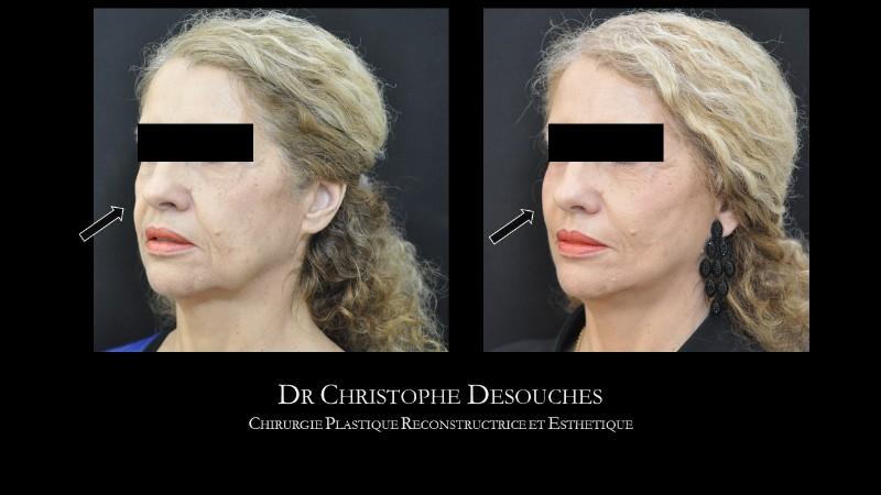 Face lift by tensor wire, without surgery