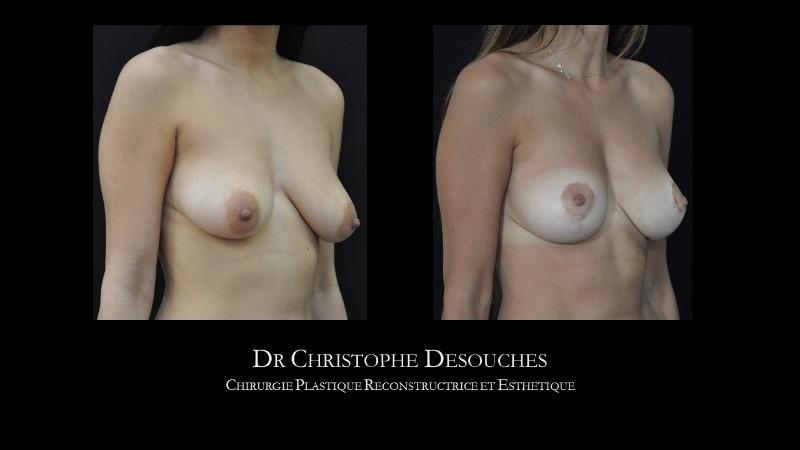 Breast lift and lipofilling