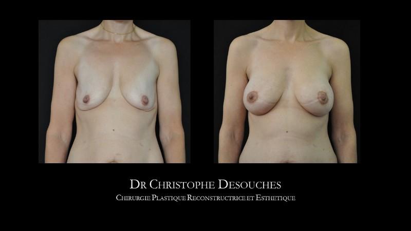 Breast lift with prosthesis