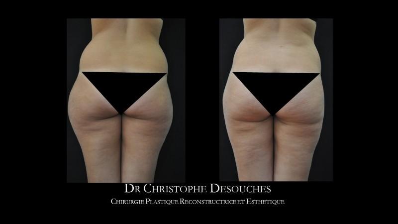 Thigh liposuction