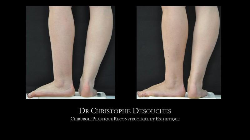 Calf liposuction