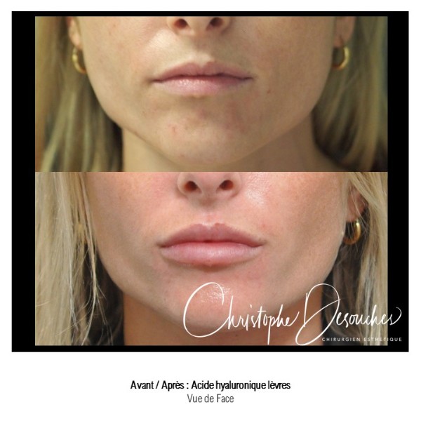 Lip augmentation by injection of Hyaluronic Acid