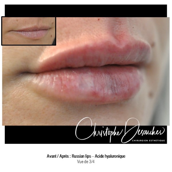 "Russian lips" - Lip augmentation by injection of hyaluronic acid