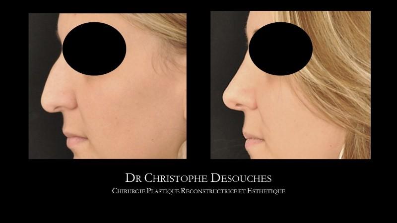 Rhinoplastie chirurgicale