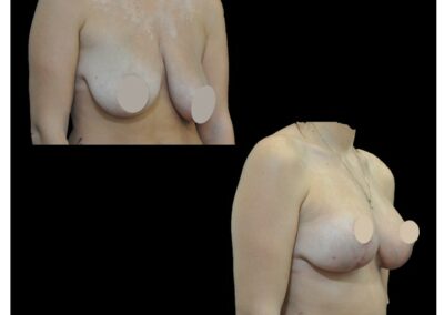 Levantamiento de senos y lipofilling