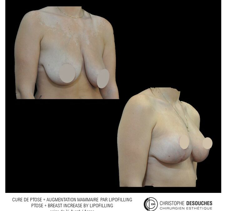 Breast lift and lipofilling