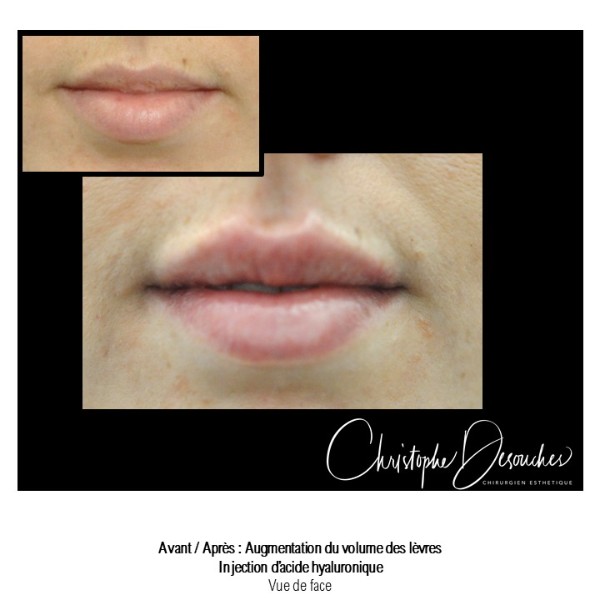 Lip augmentation / lip augmentation by injection of hyaluronic acid