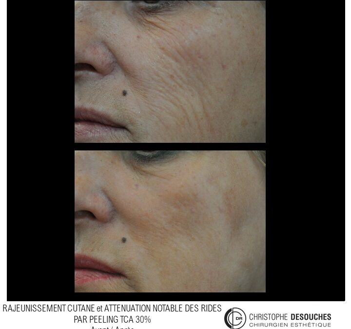 Medium peel