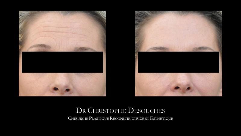 Botox injection or botulinum toxin before after photo