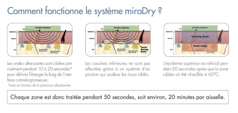 Miradry (sudorazione eccessiva)