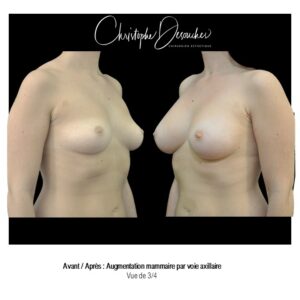 Breast augmentation with prostheses