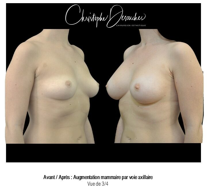 Breast augmentation with prostheses