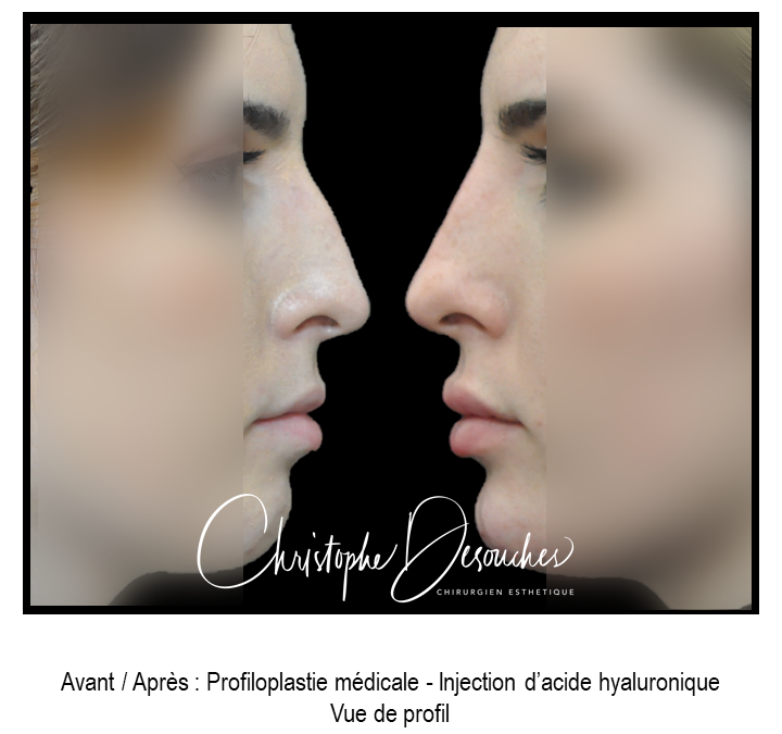 Medical profiloplasty by injection of hyaluronic acid
