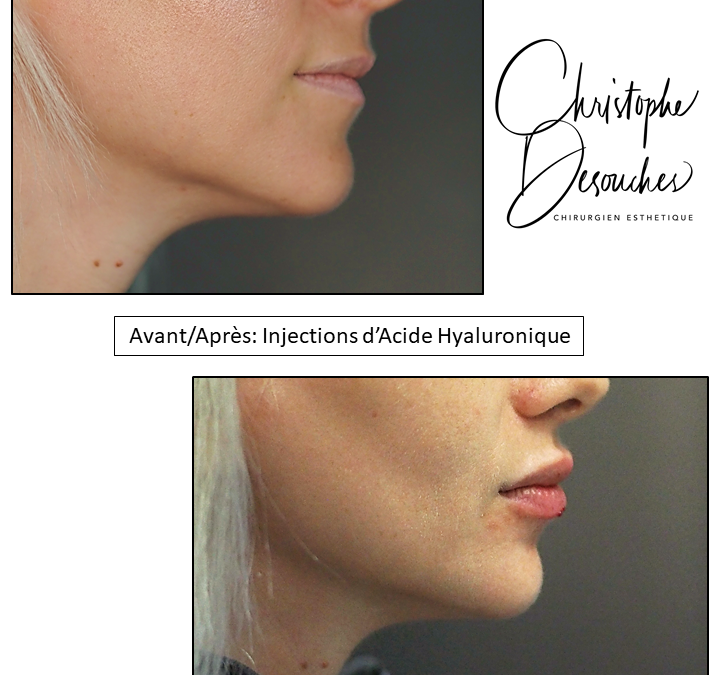Increase in lip volume by injections of hyaluronic acid