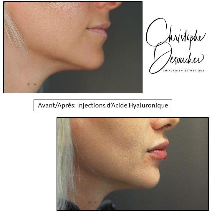 Increase in lip volume by injections of hyaluronic acid