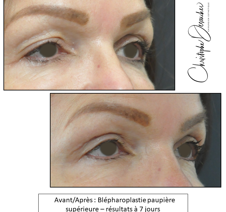 Blépharoplastie paupières supérieures