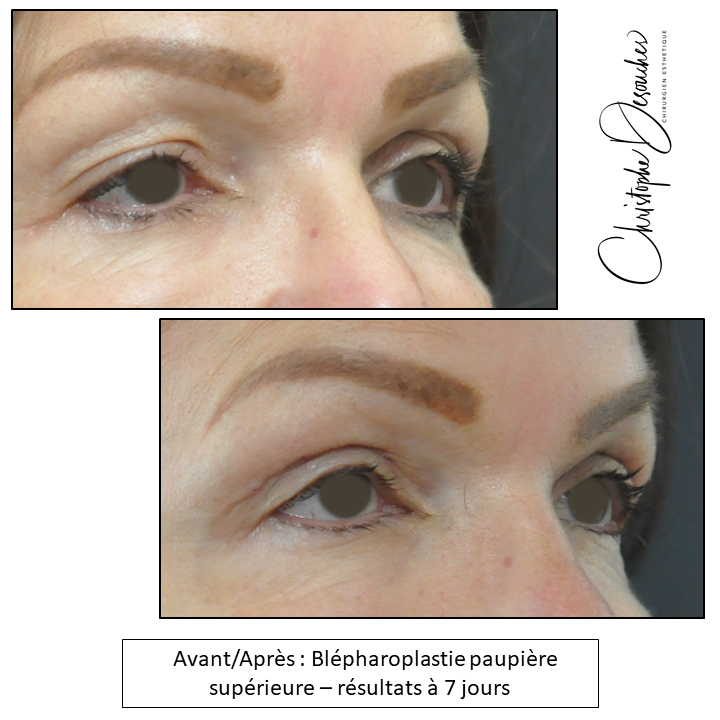 Blépharoplastie paupières supérieures