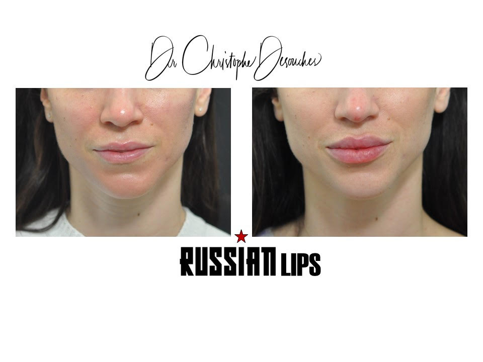 Christophe Desouches Marseille Russian Lips with hyaluronic acid lip injection