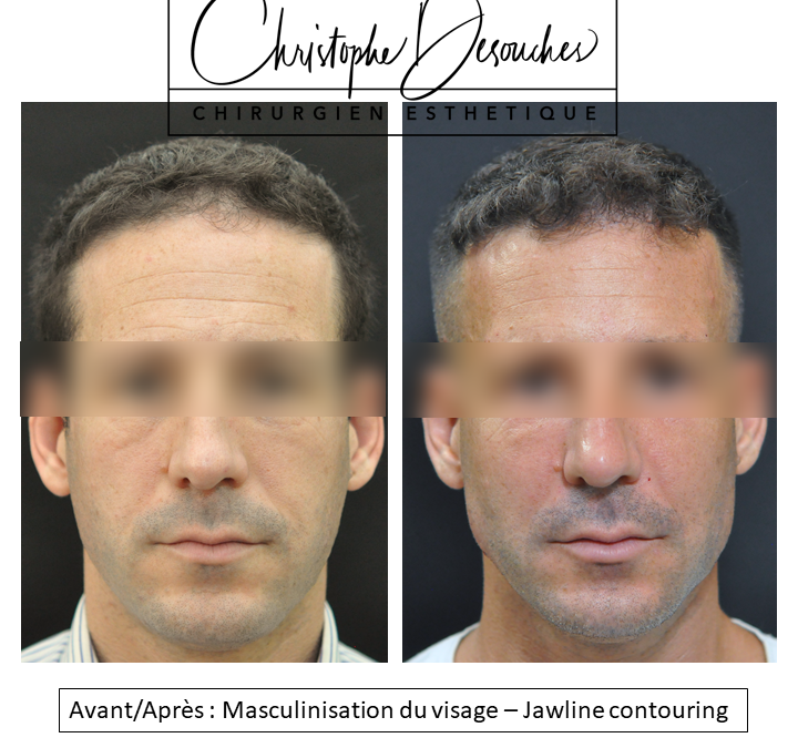 Masculinisation du visage