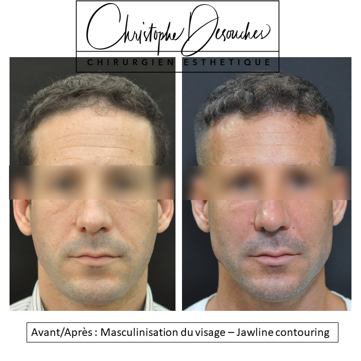 Masculinización del rostro